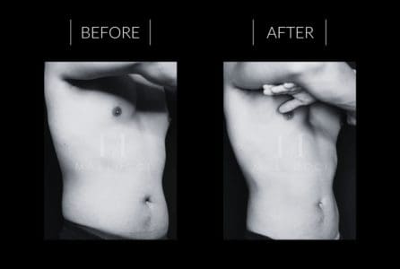 CoolSculpting Results London