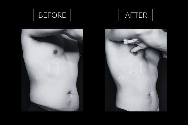 CoolSculpting Results London